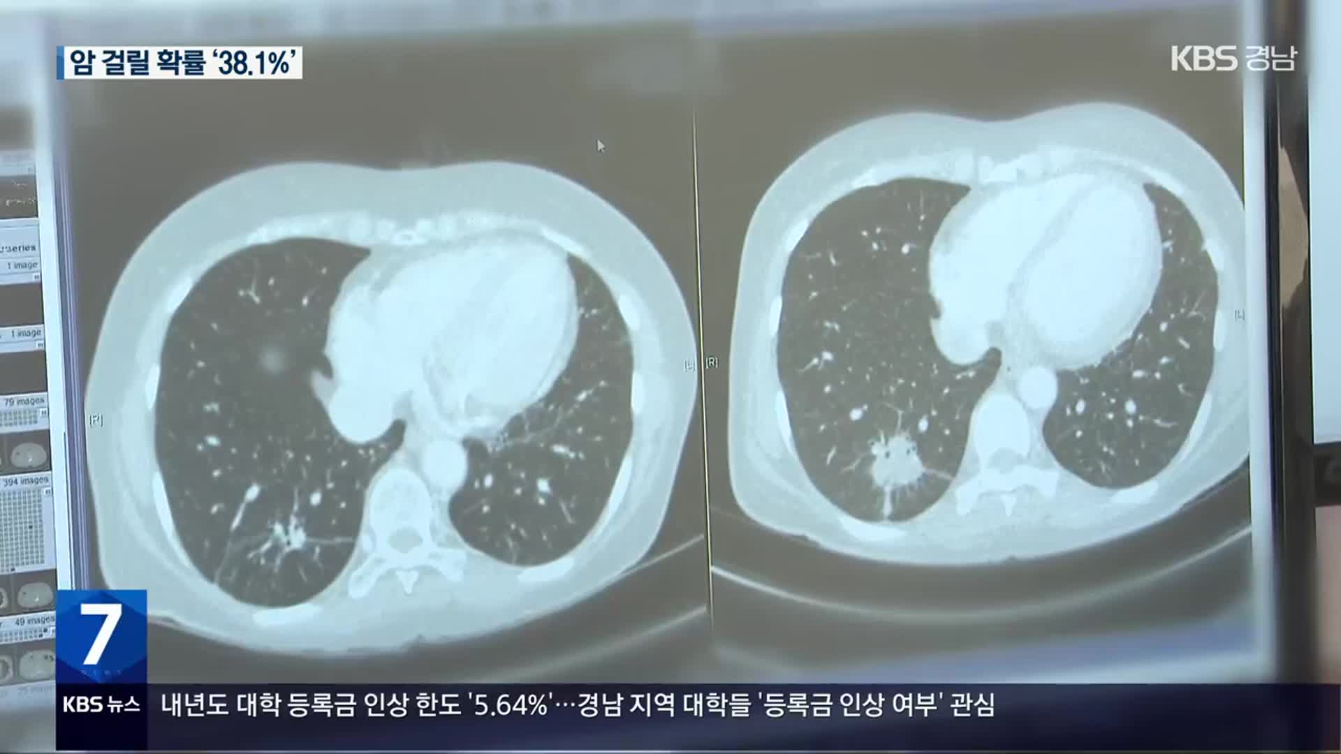 21년 신규 암환자 27만여 명…생존율은 증가 추세