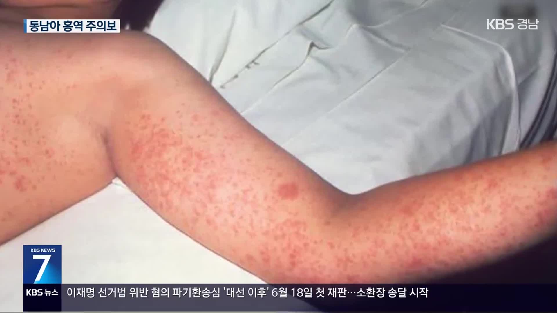 동남아 여행 뒤 홍역 환자 증가…귀국 후 발열 주의