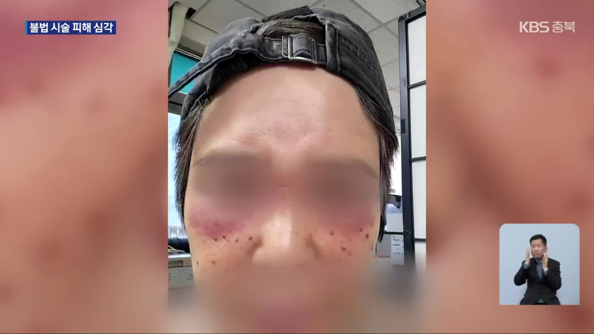 “싸고 효과 좋아” 불법 피부 시술…후유증 심각