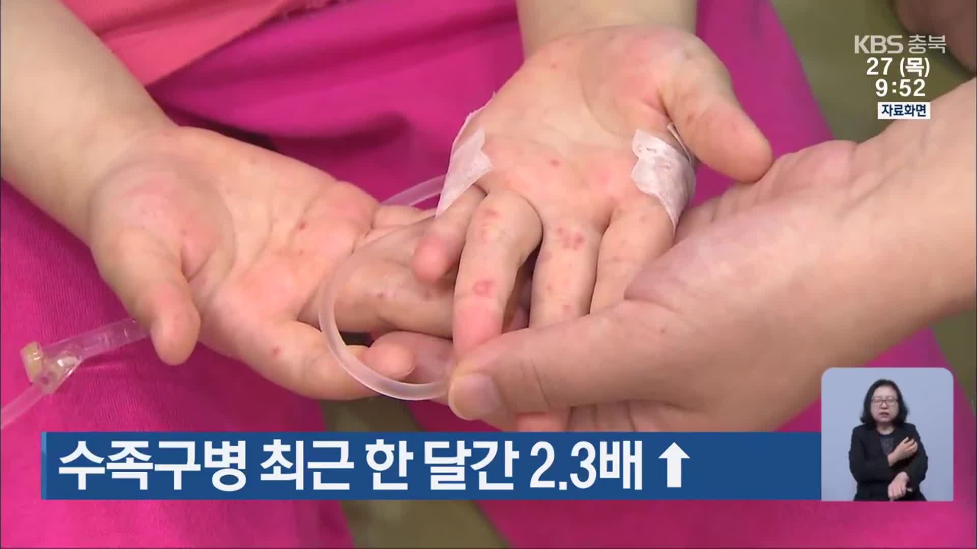 수족구병 최근 한 달간 2.3배↑