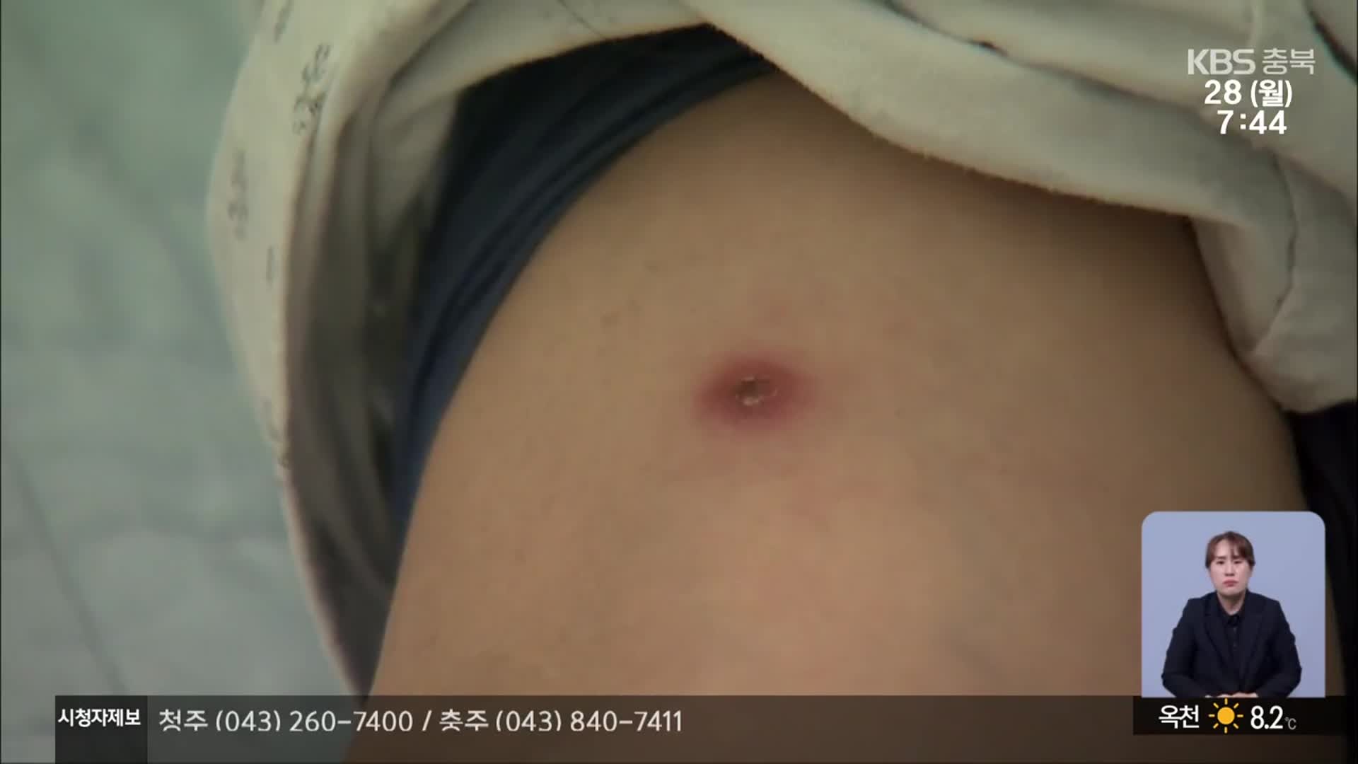 진드기 매개 감염 비상…“고령층 주의”