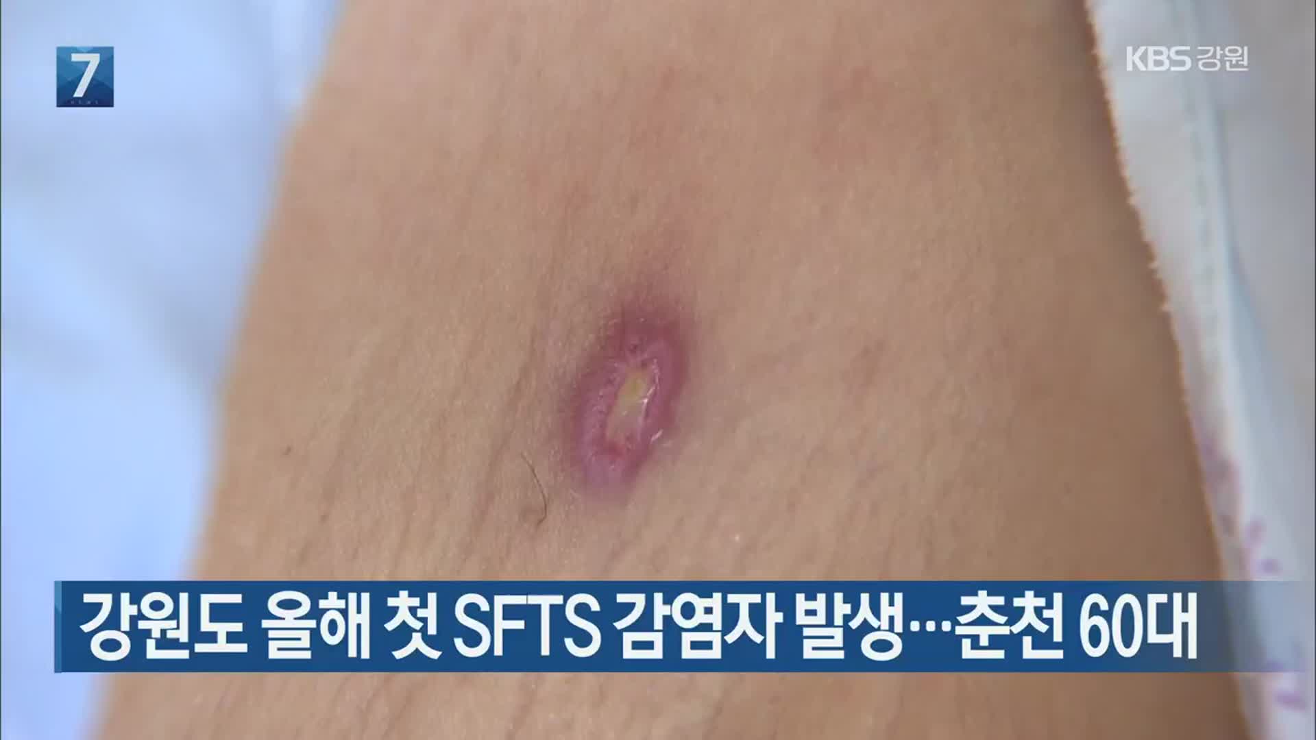 강원도 올해 첫 SFTS 감염자 발생…춘천 60대