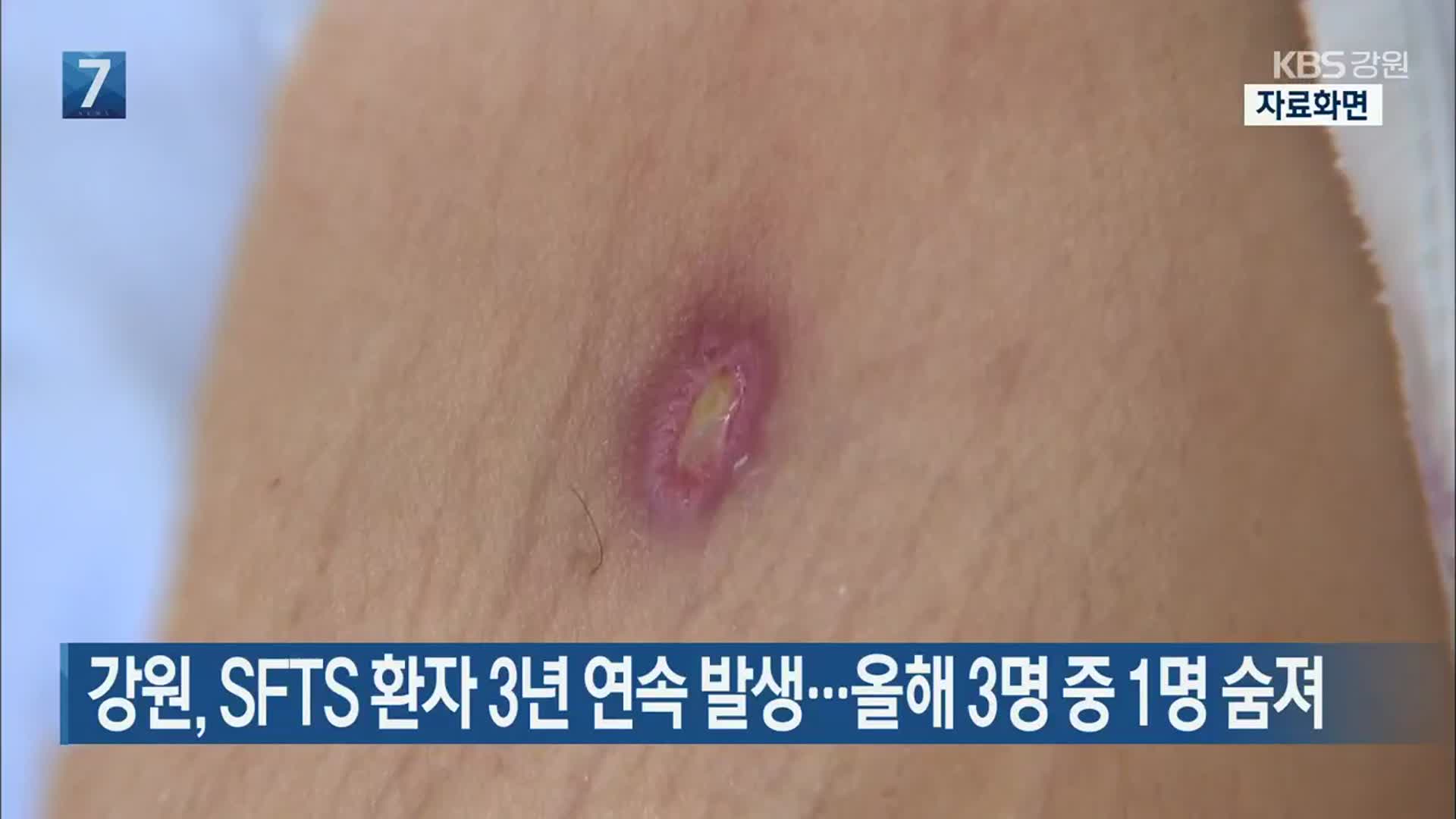 강원, SFTS 환자 3년 연속 발생…올해 3명 중 1명 숨져