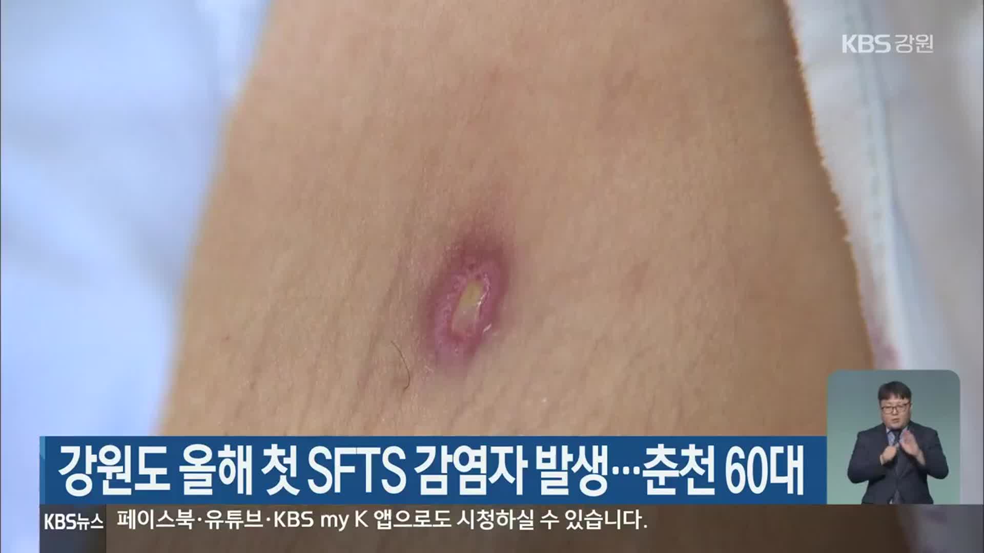 강원도 올해 첫 SFTS 감염자 발생…춘천 60대