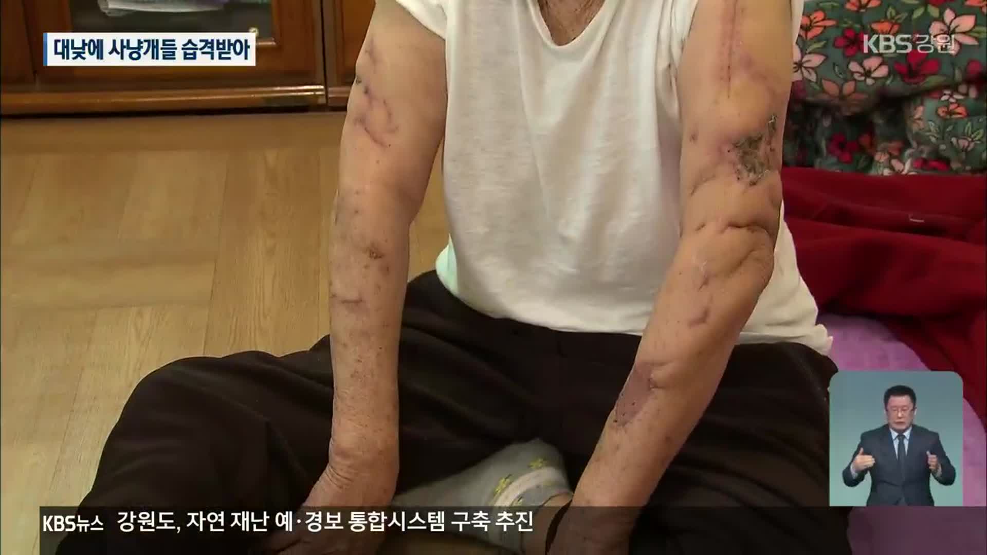 대낮 사냥개들의 습격…80대 여성 온몸 물어뜯겨