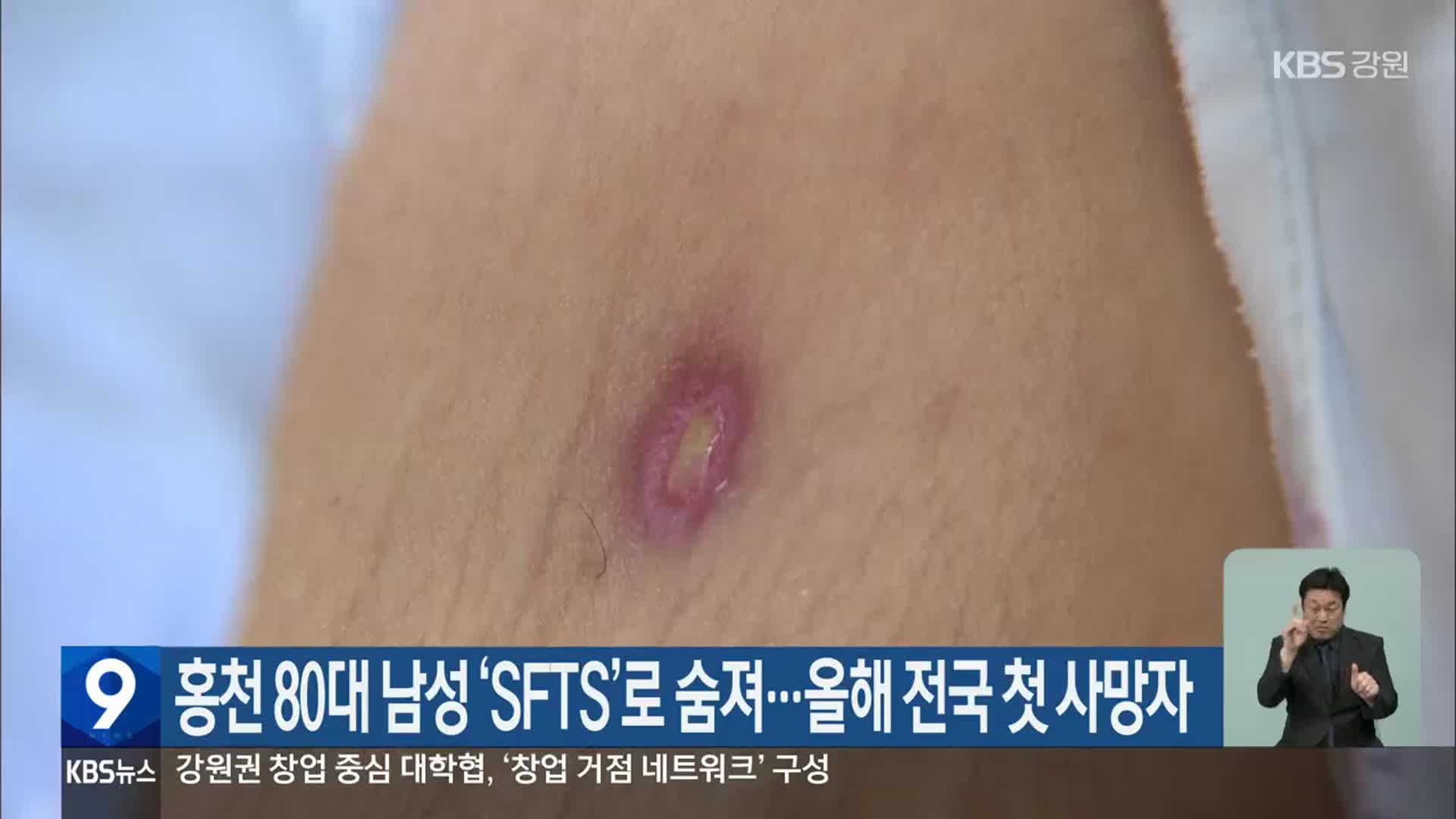 홍천 80대 남성 ‘SFTS’로 숨져…올해 전국 첫 사망자