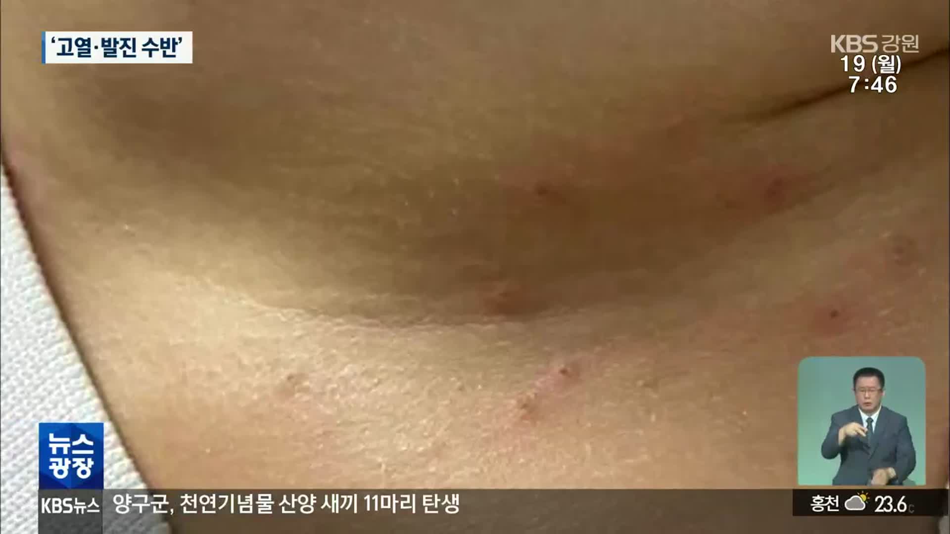 3년 만에 ‘수족구병’ 유행…영유아 중심 확산