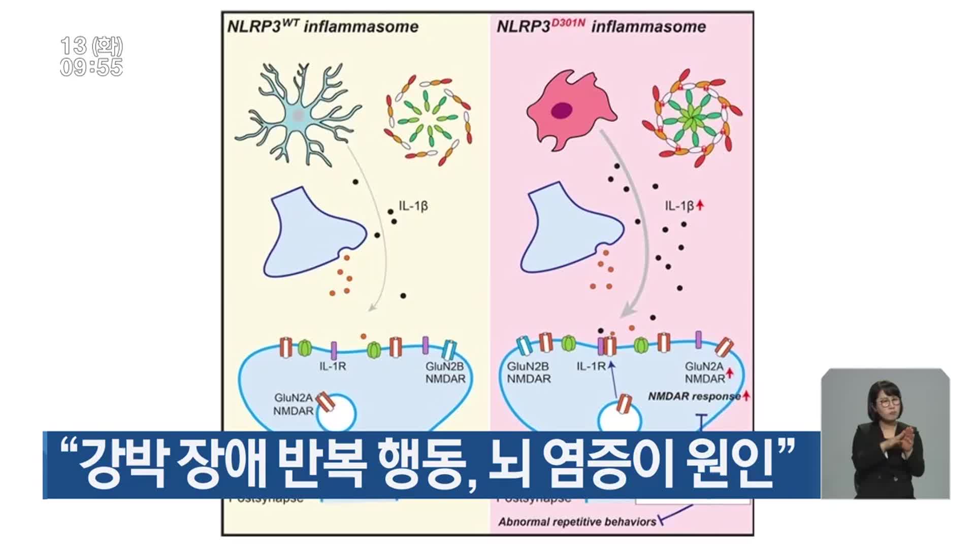 “강박 장애 반복 행동, 뇌 염증이 원인”