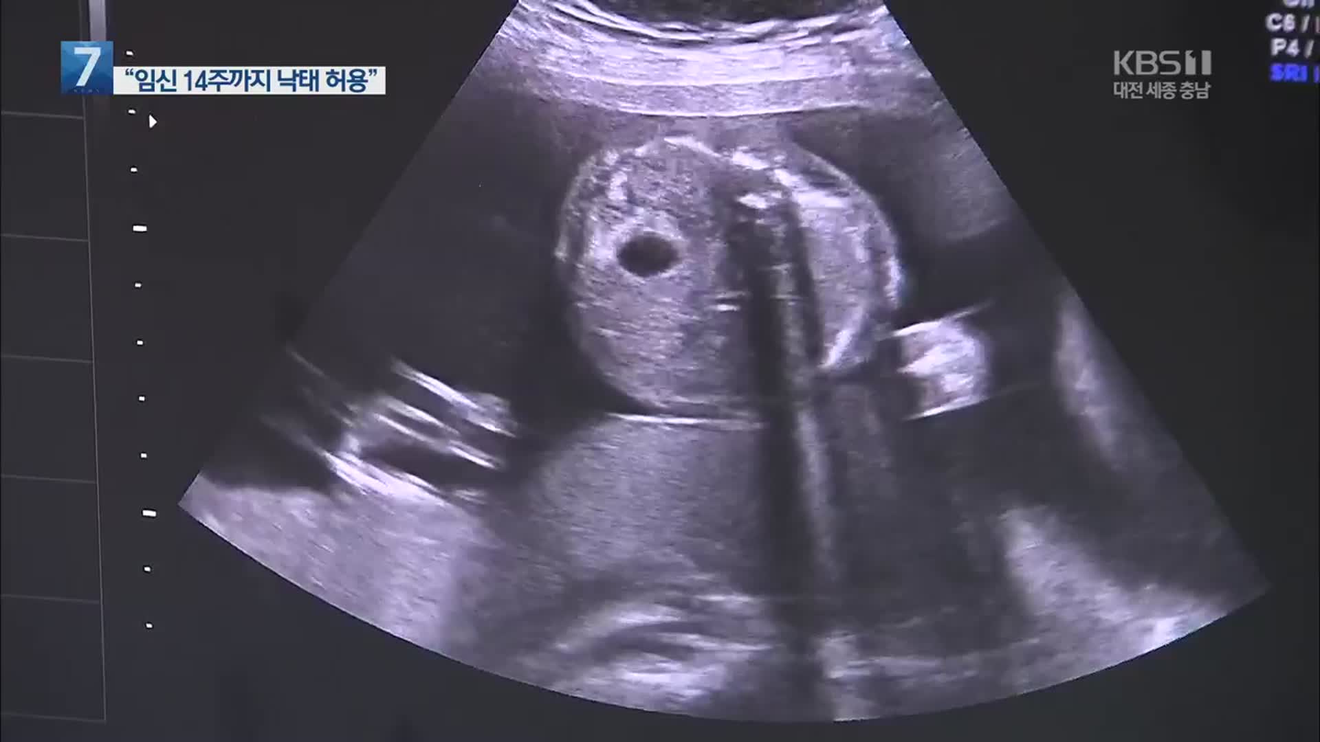 ‘임신 14주 이내 낙태 허용’ 내일 입법예고