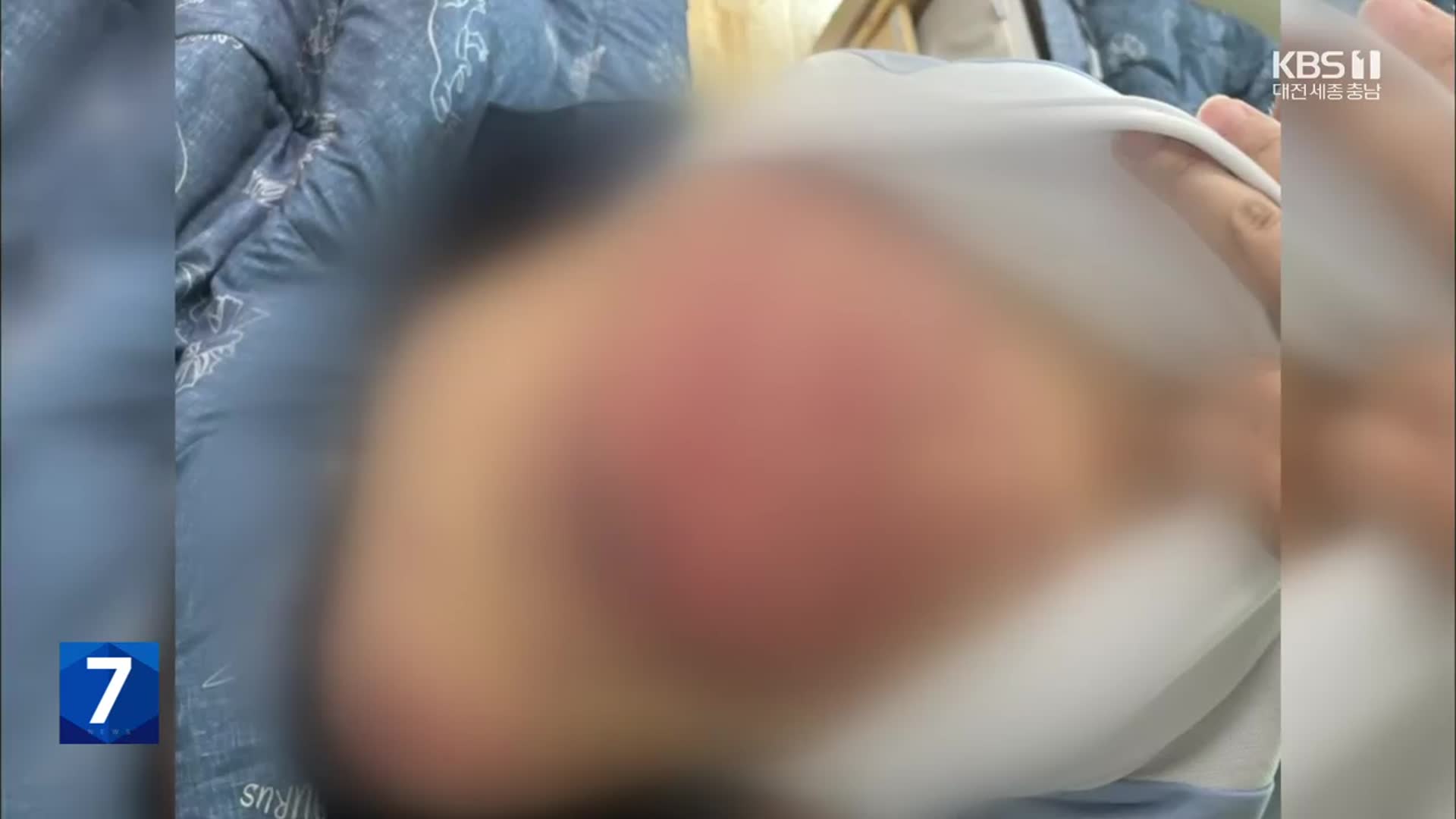 “귀신 씌어서”…8살 초등생 온 몸 멍투성이