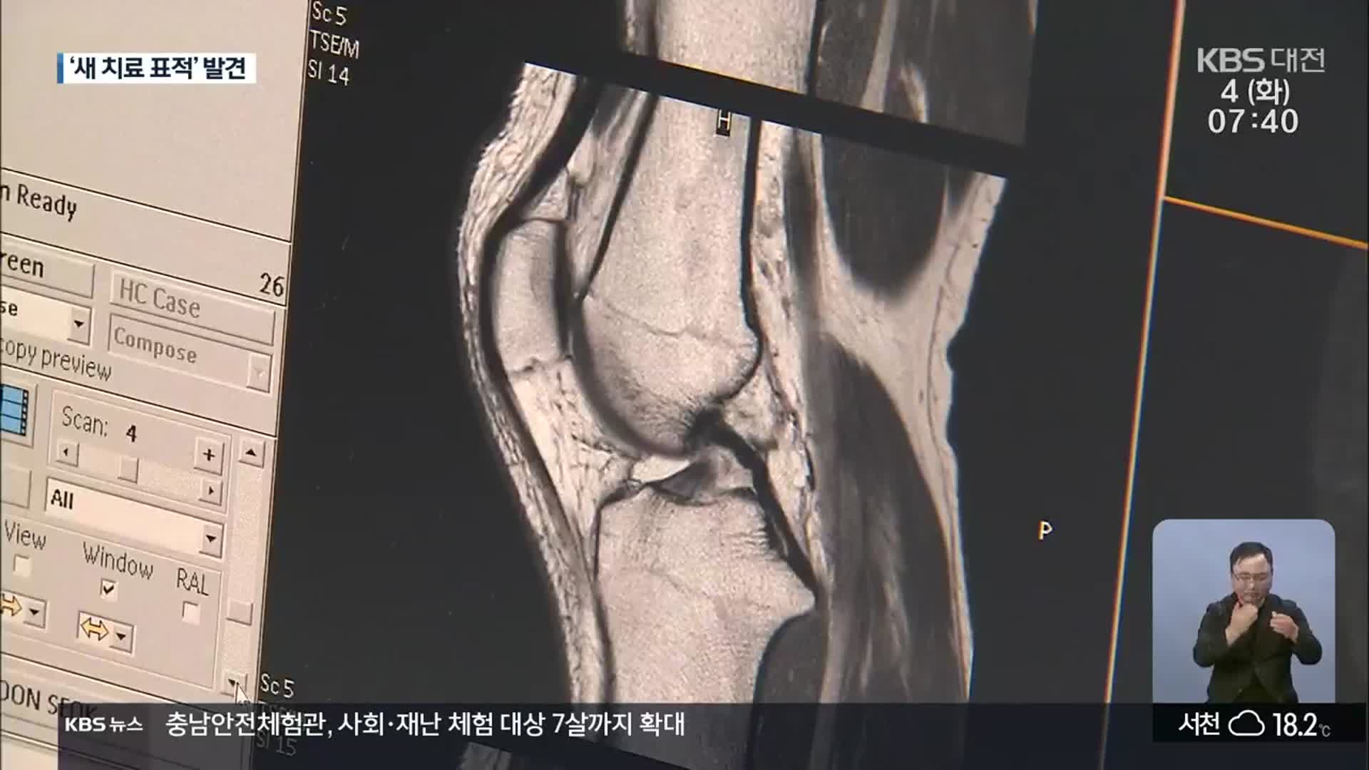 인지장애 동반하는 류마티스 관절염, 새로운 치료 표적 찾아