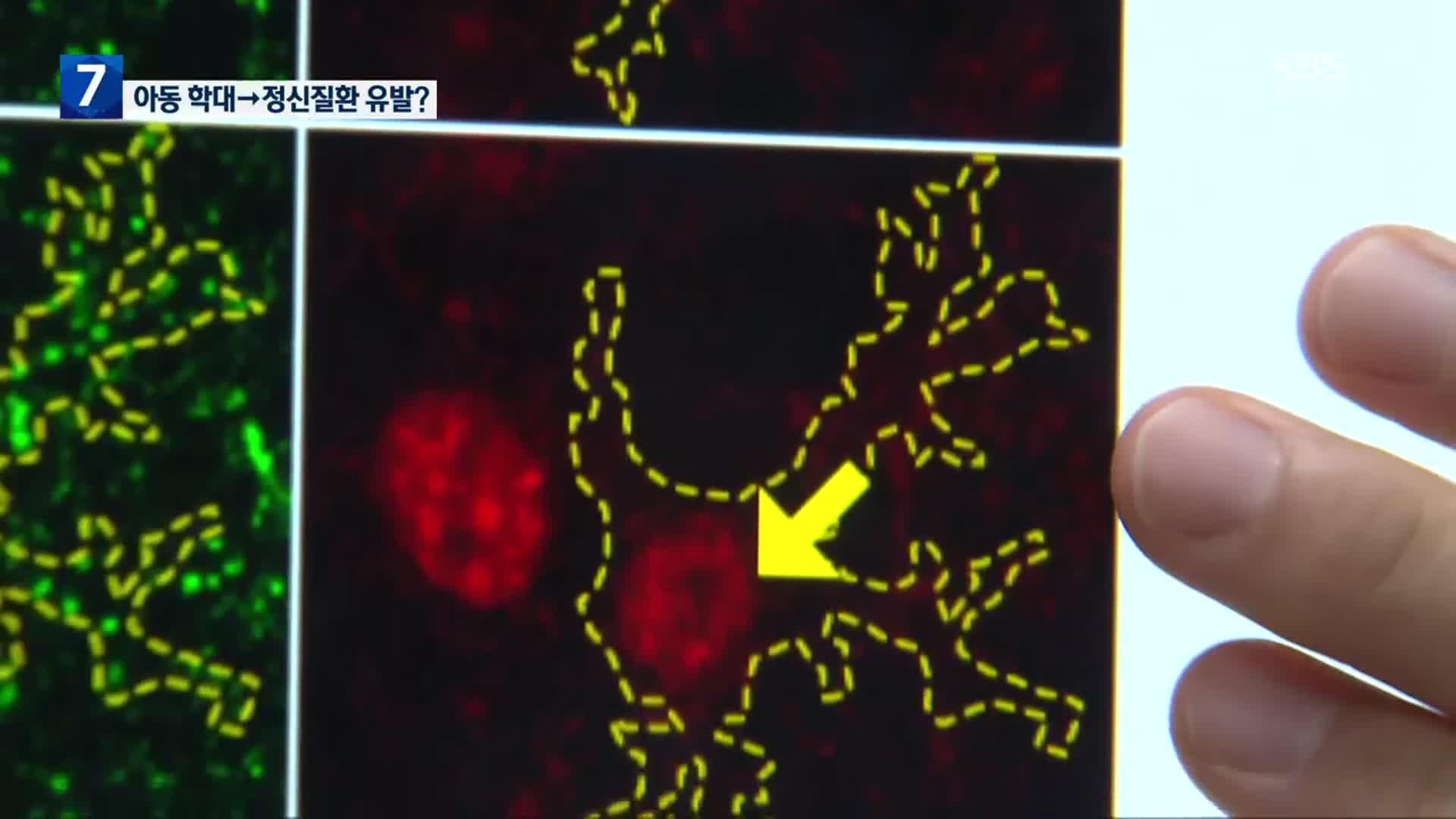 ‘아동기 학대가 정신질환 유발’ 첫 규명