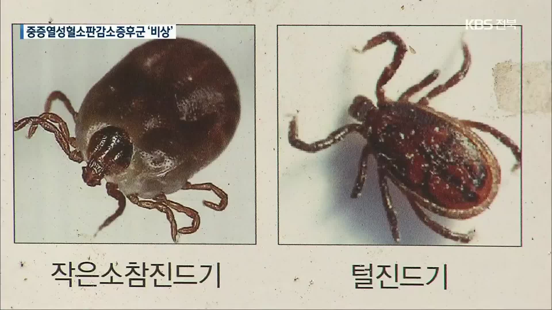 가을철 불청객 ‘중증열성혈소판감소증후군’ 비상