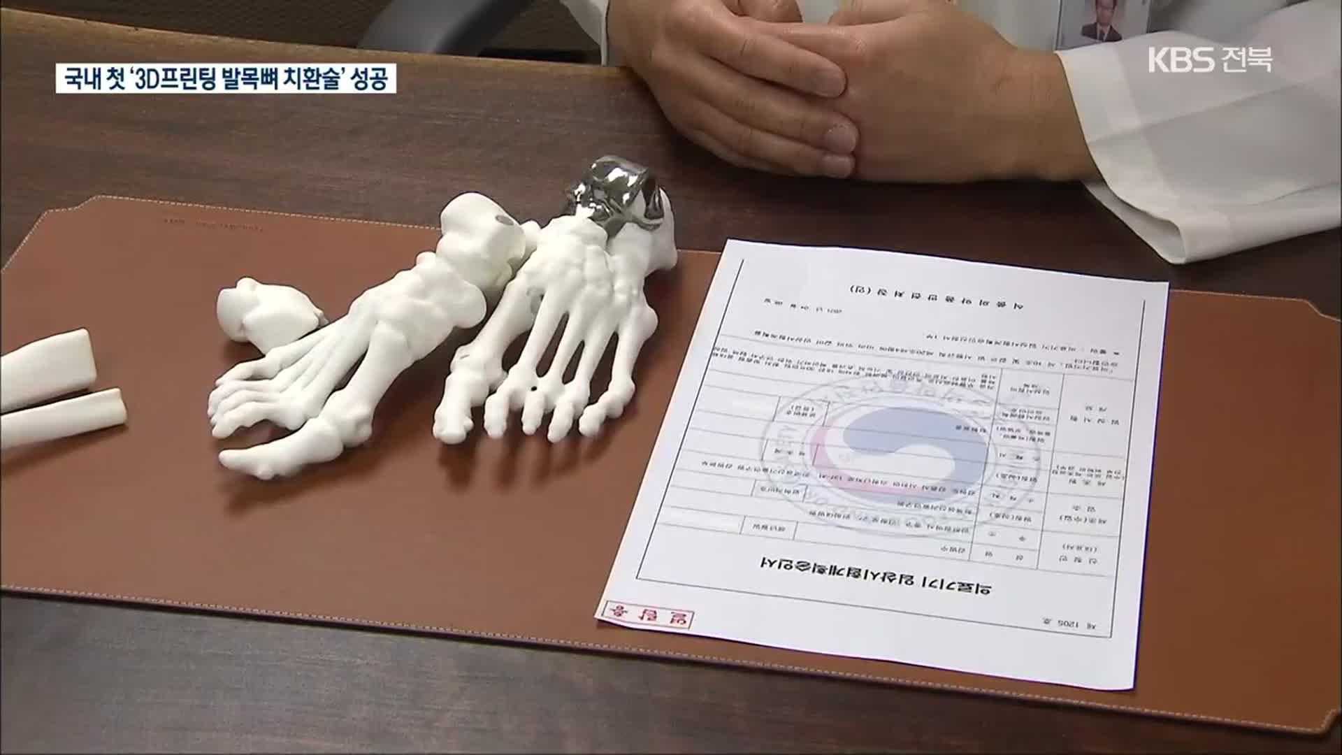 국내 첫 ‘3D프린팅 발목뼈 치환술’ 성공…의료계 확산