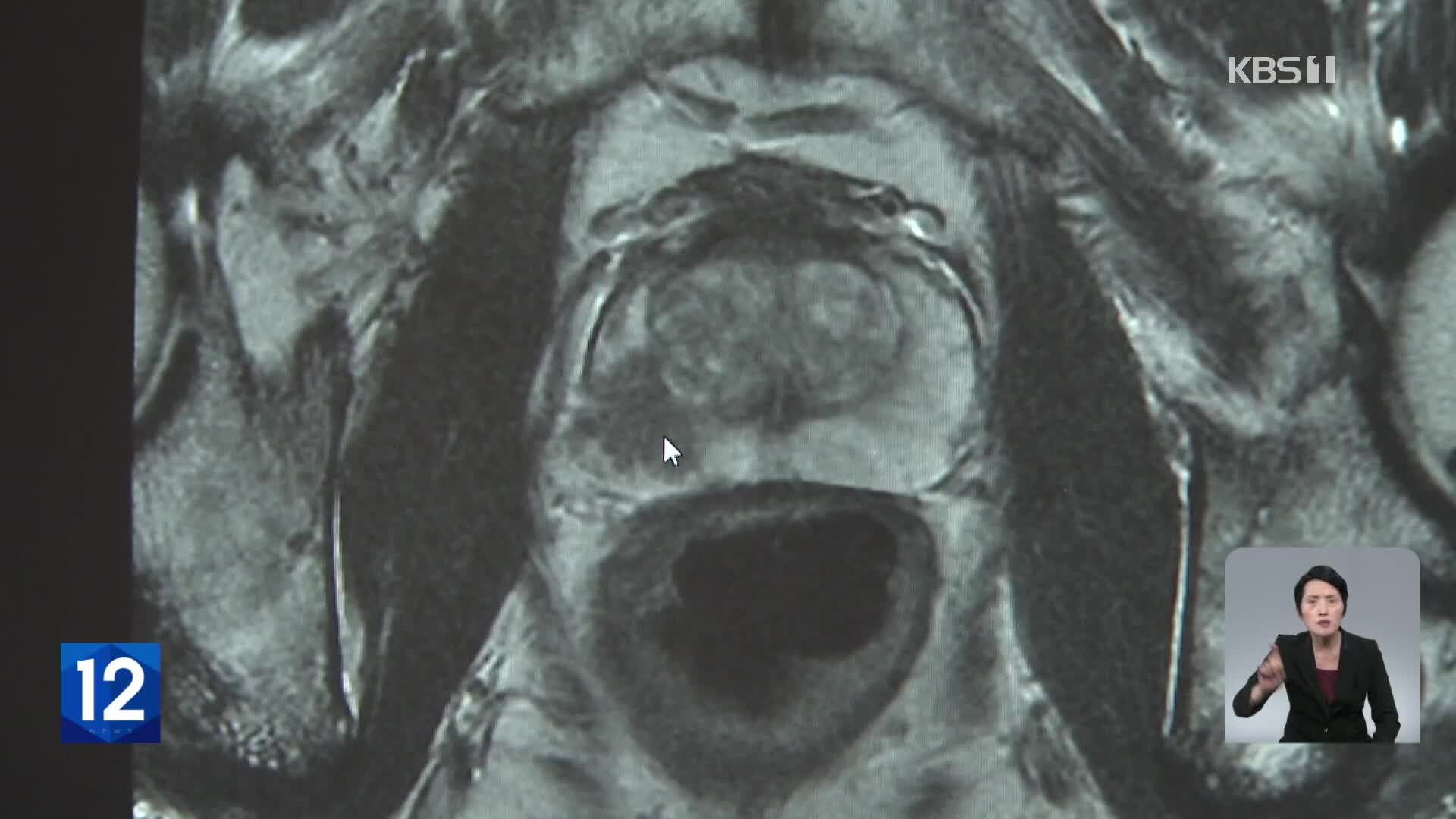 전립선암 2명 중 1명 ‘진행 뒤’ 발견…조기 진단하려면?