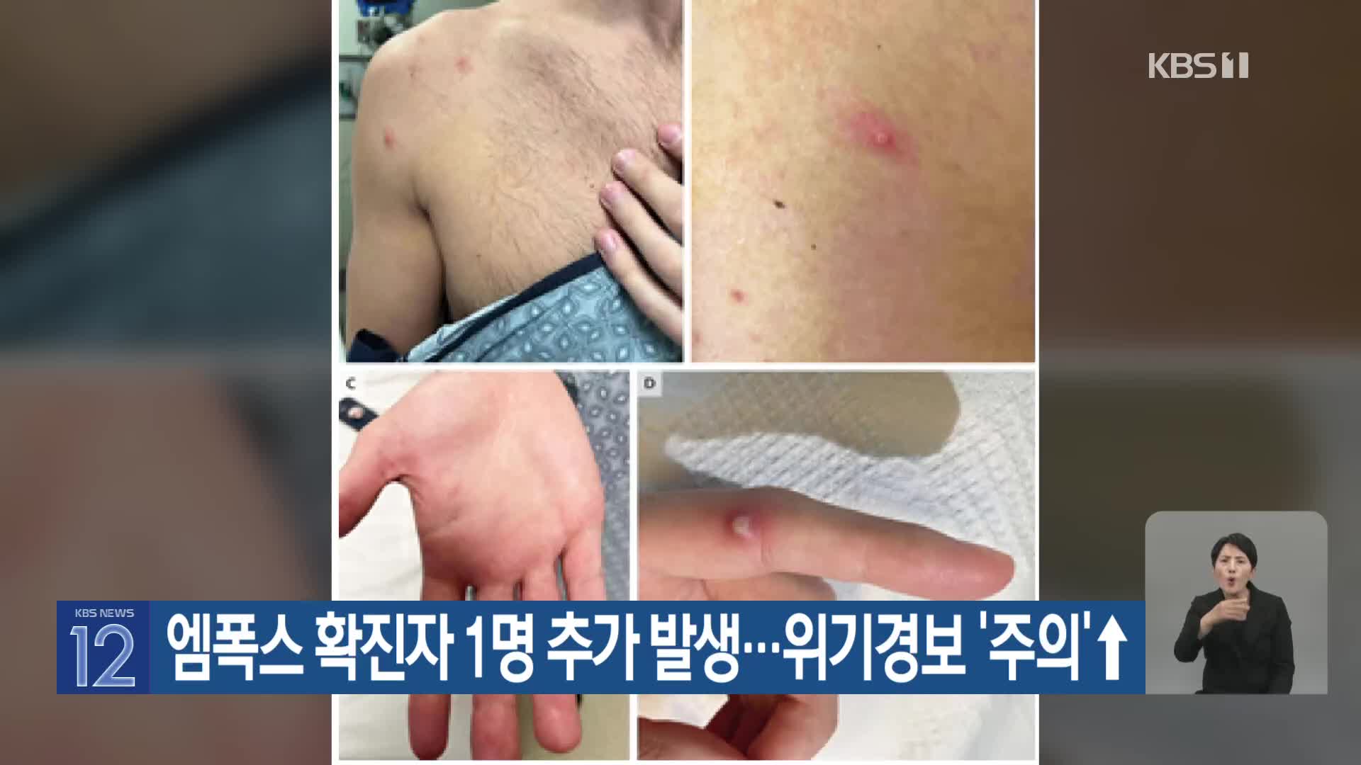 엠폭스 확진자 1명 추가 발생…위기경보 ‘주의’↑