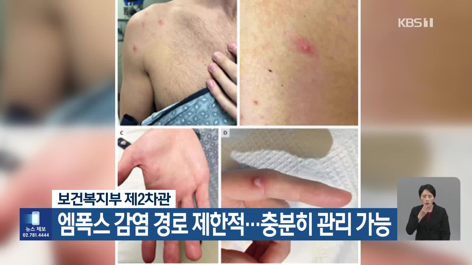 보건복지부 제2차관 “엠폭스 감염 경로 제한적…충분히 관리 가능”