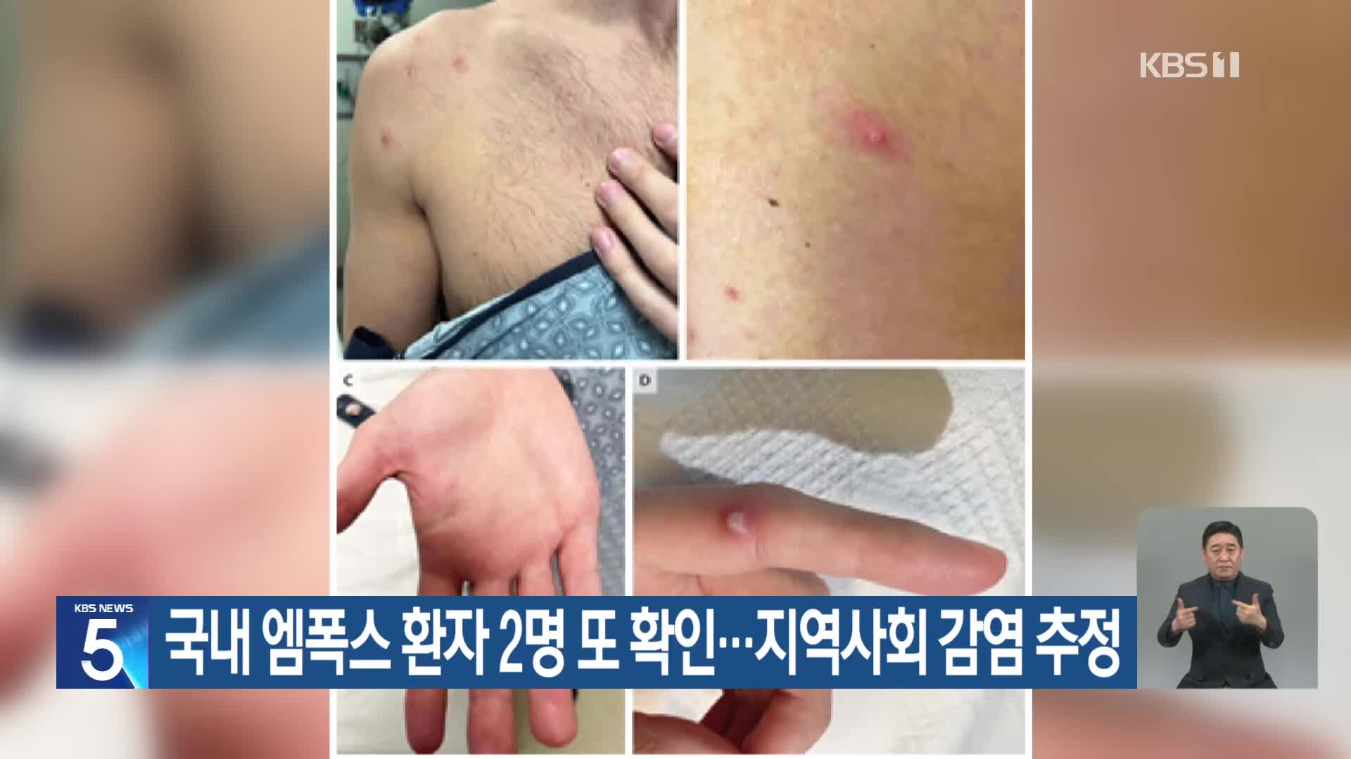 국내 엠폭스 환자 2명 또 확인…지역사회 감염 추정