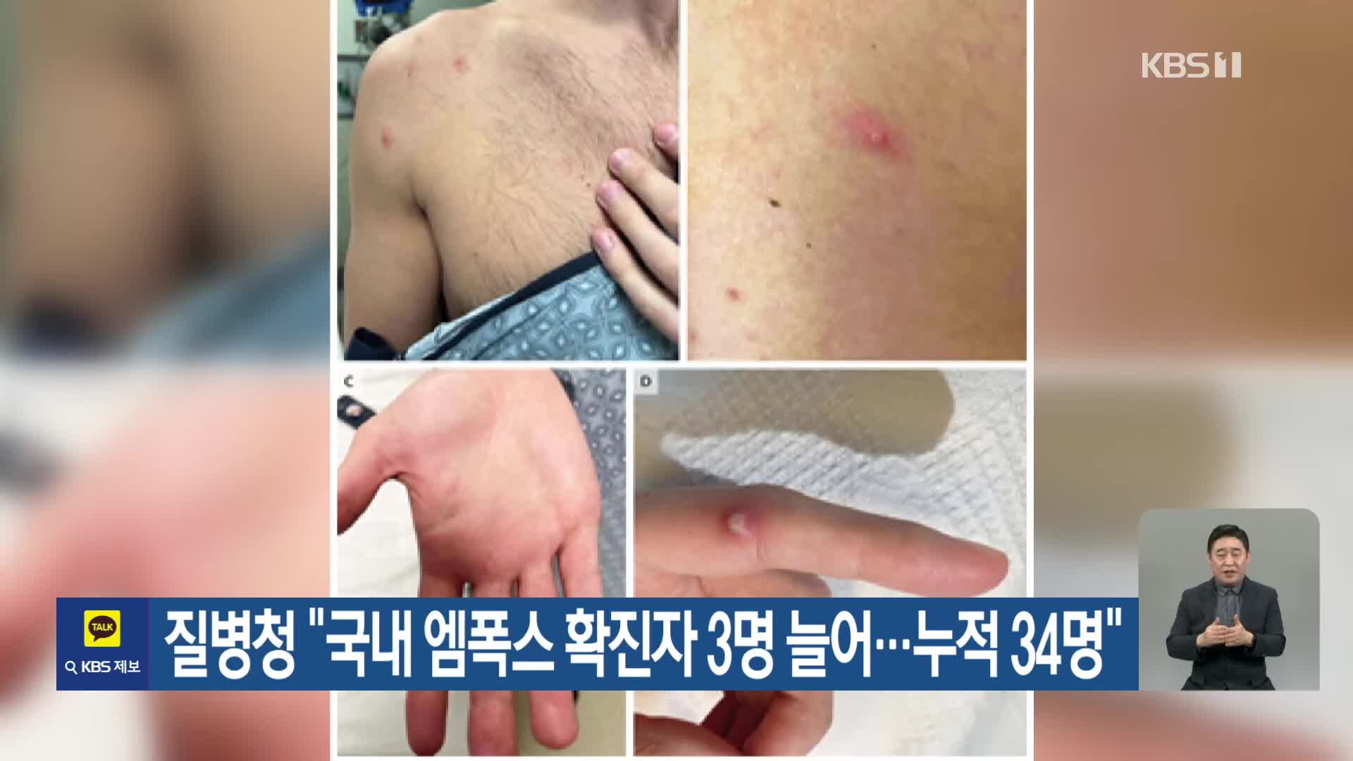 질병청 “국내 엠폭스 확진자 3명 늘어…누적 34명”