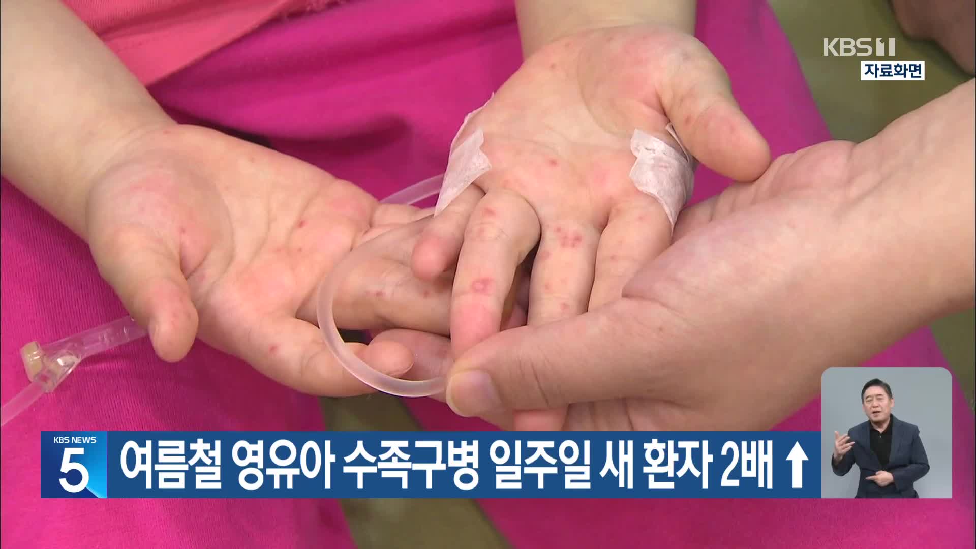 여름철 영유아 수족구병 일주일 새 환자 2배 ↑