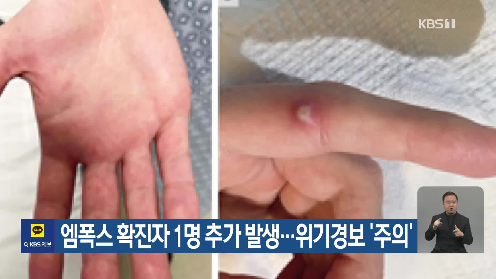 엠폭스 확진자 1명 추가 발생…위기경보 ‘주의’