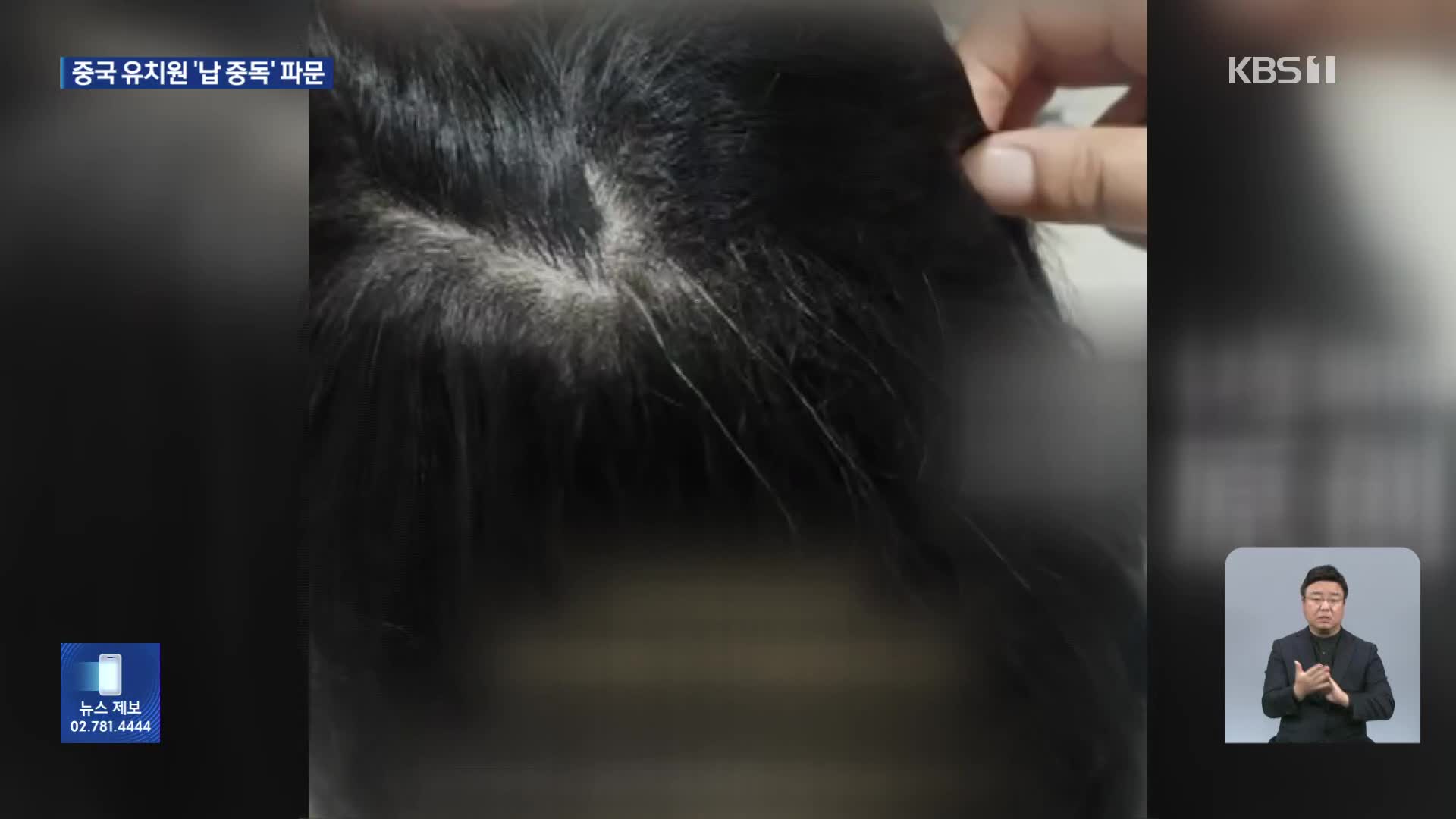 유치원생 흰머리에 이가 까맣게…떡·옥수수에 납 성분 첨가제
