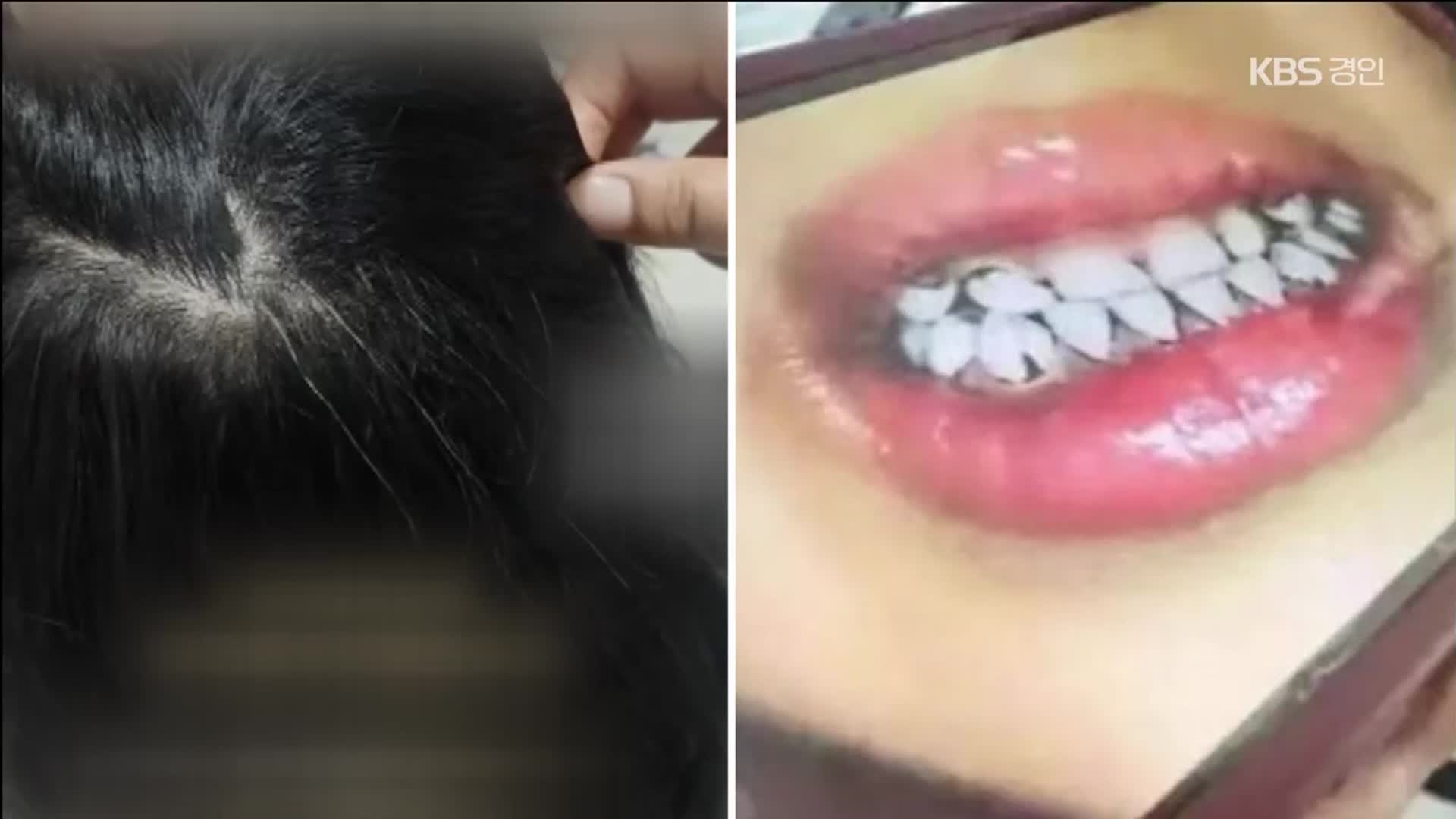 유치원생 흰머리에 이가 까맣게…떡·옥수수에 납 성분 첨가제
