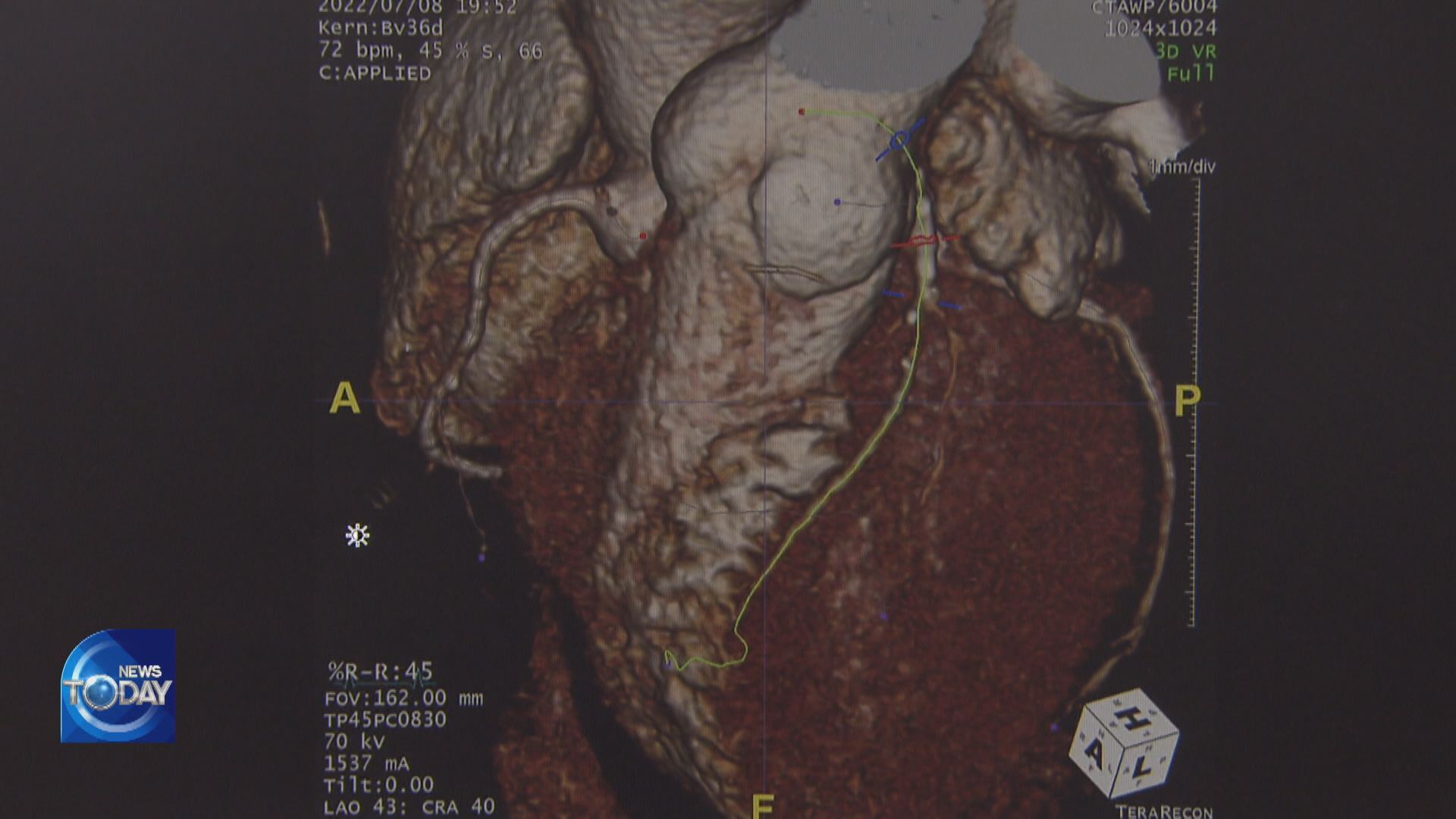 AI PROGRAM DETECTING HEART DISEASE