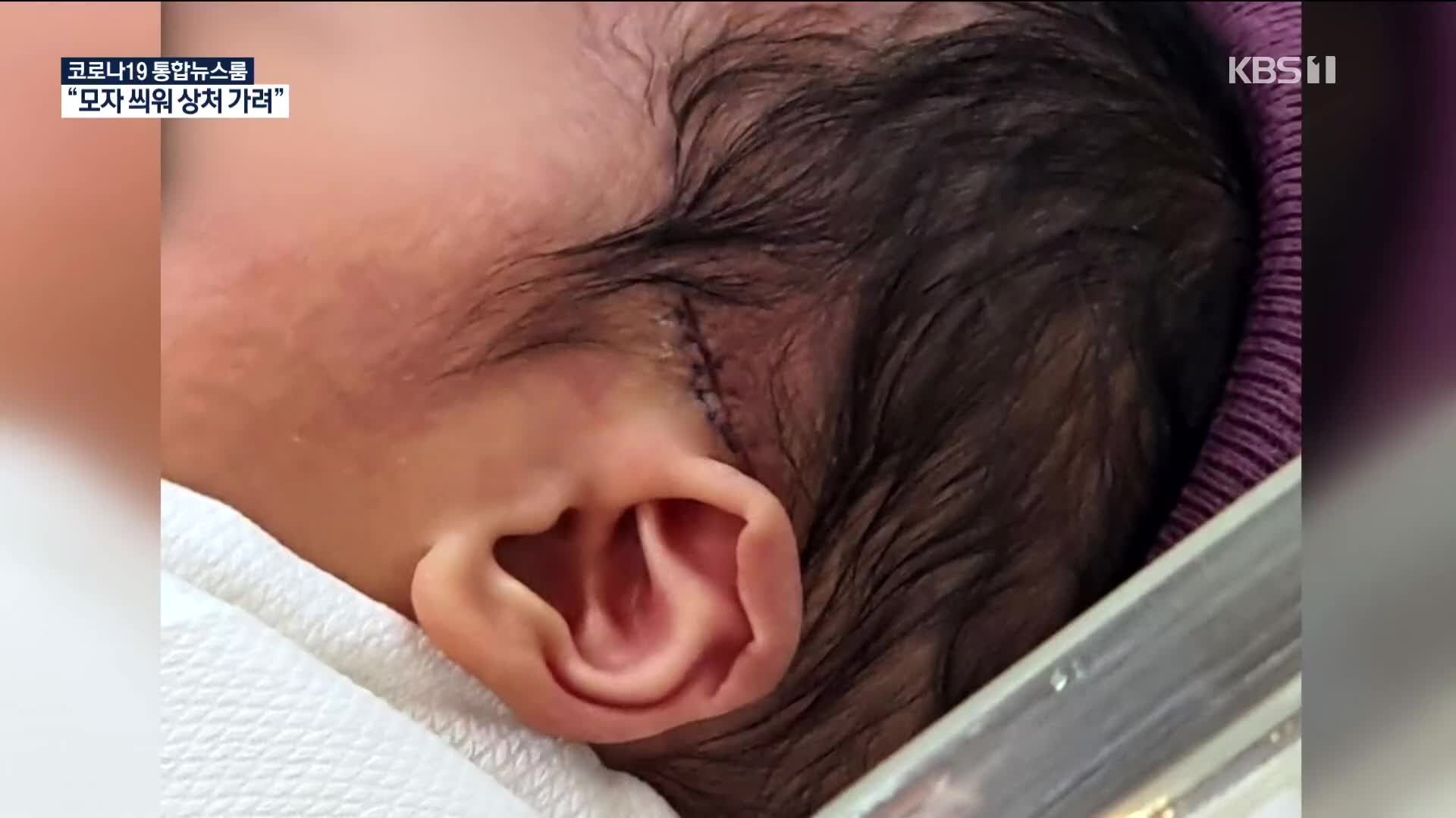 신생아 머리에 칼자국…병원은 은폐에 부실 대응