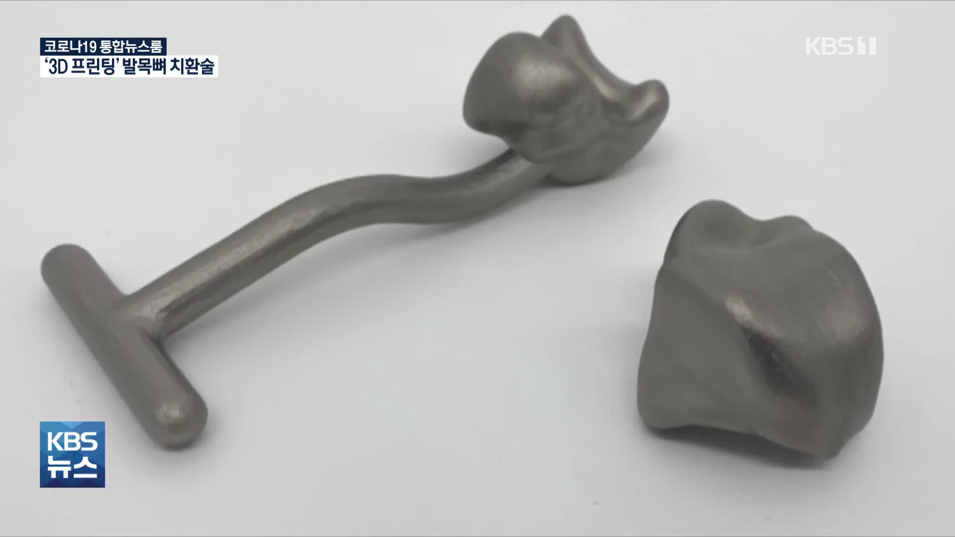 국내 첫 ‘3D프린팅 발목뼈 치환술’ 성공…의료계 확산