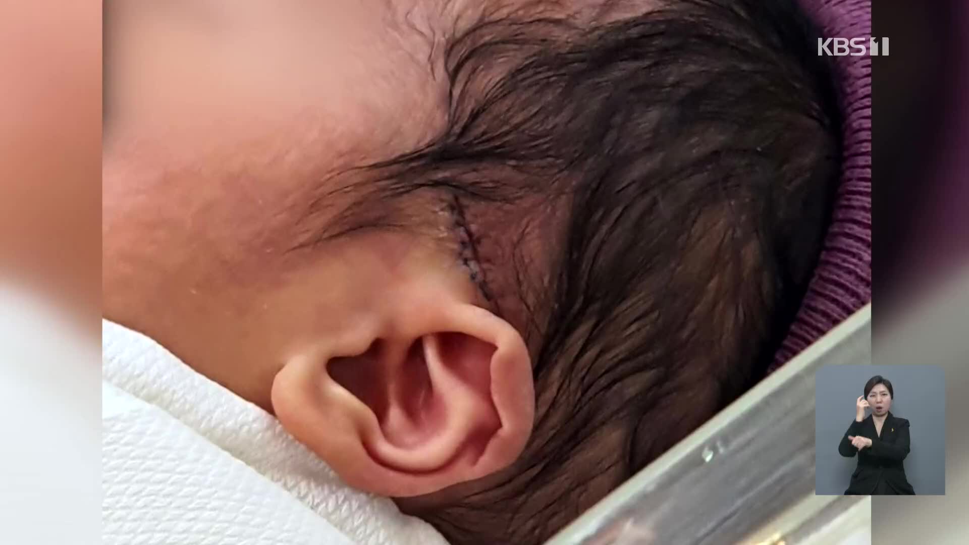 제왕절개 신생아 머리에 칼자국…병원은 은폐에 부실 대응