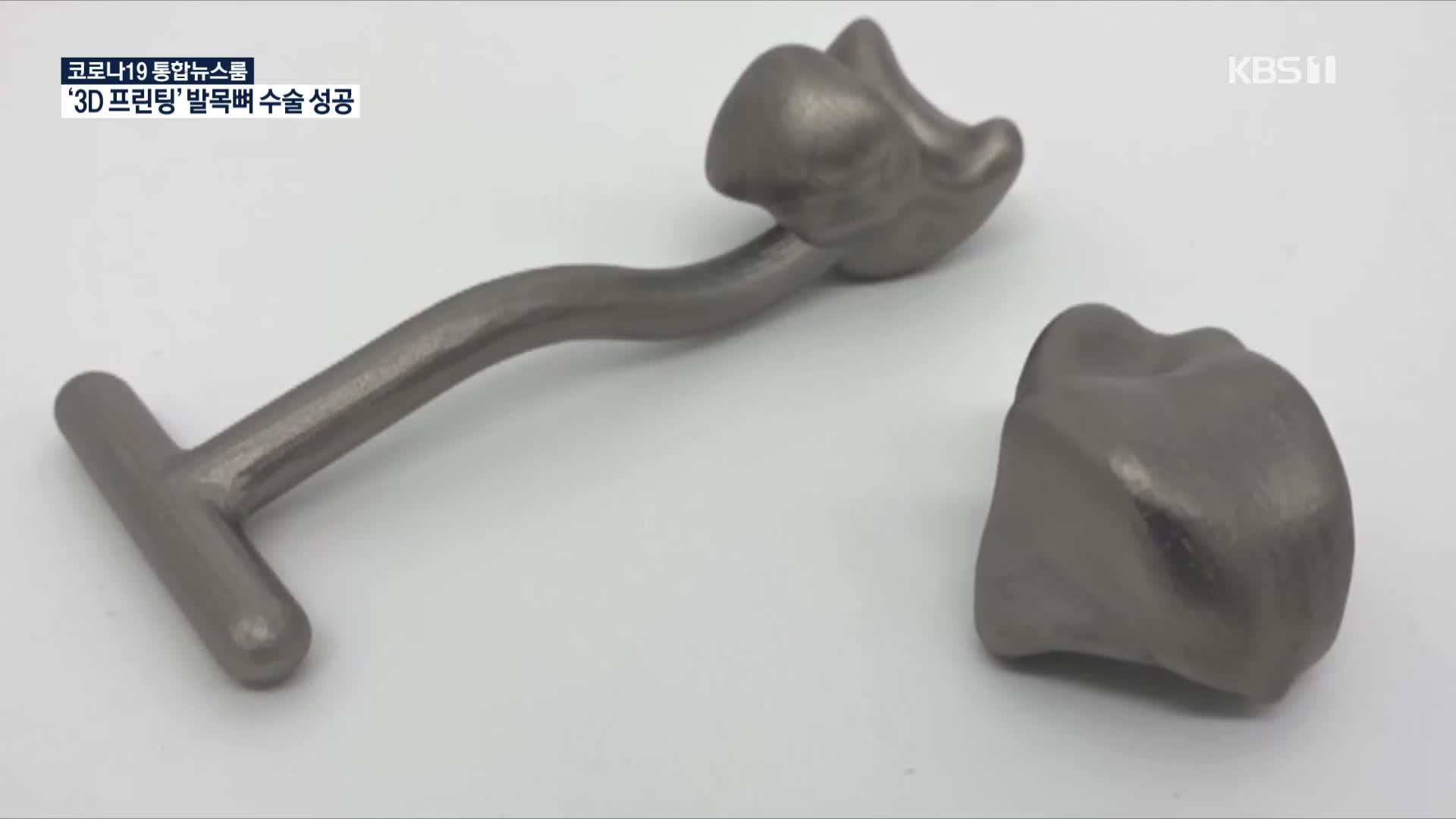 국내 첫 ‘3D 프린팅 발목뼈 치환술’ 성공…의료계 확산