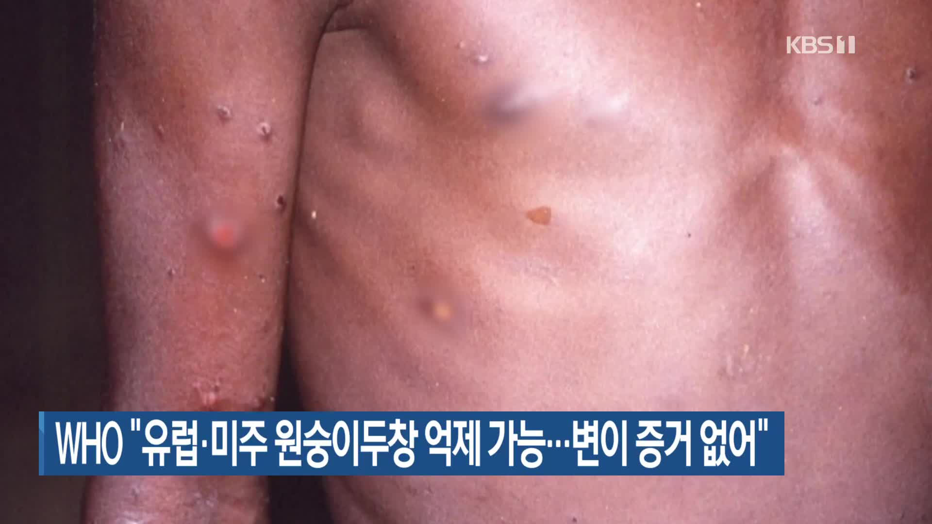 WHO “유럽·미주 원숭이두창 억제 가능…변이 증거 없어”