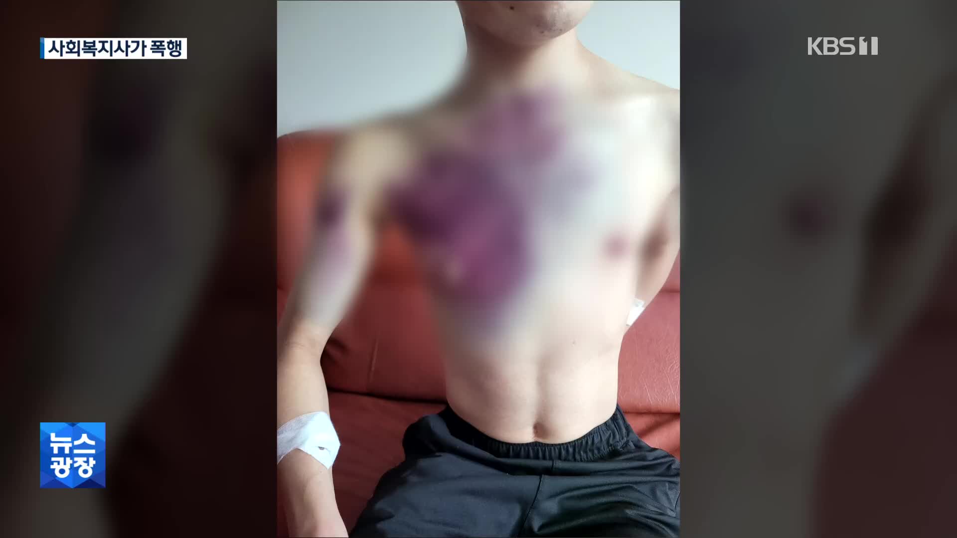 사회복지사가 장애인 폭행…“갈비뼈 2개 부러져”