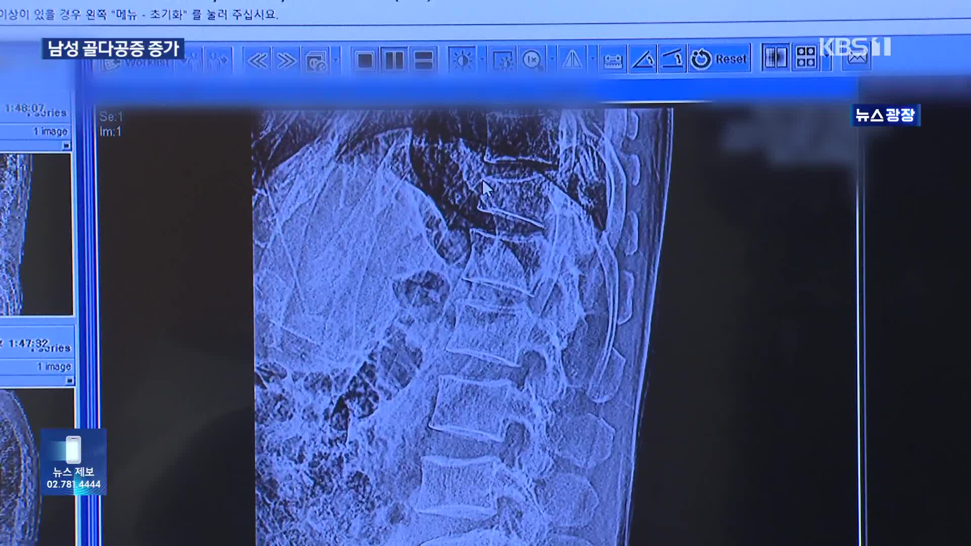 남성도 ‘골다공증’…“70세 이상 5명 중 1명”