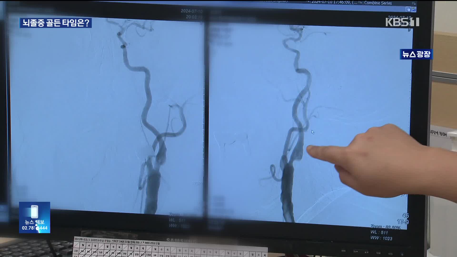 뇌졸중 치료 골든타임 3시간으로 제한?…“최대 24시간 내 치료 가능”