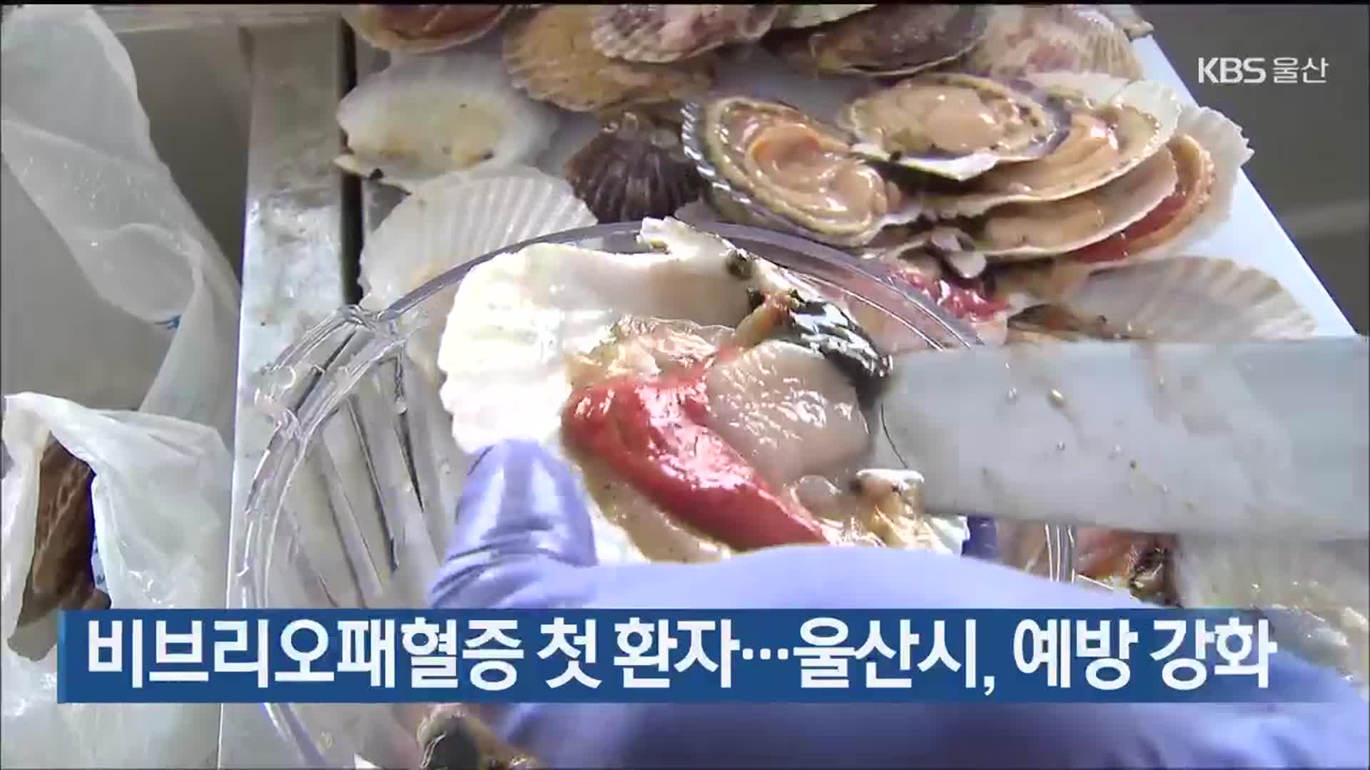 비브리오패혈증 첫 환자…울산시, 예방 강화