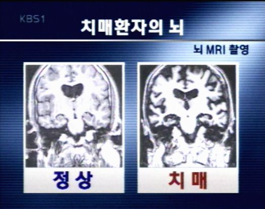 '치매' 초기에 찾아낸다 