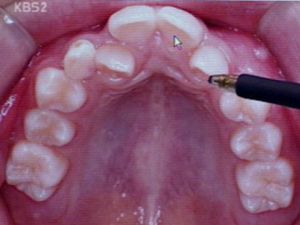 어린이 치열 불량…서구형 얼굴이 원인 