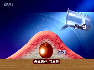 초등학교서 또 실험사고 3명 부상 