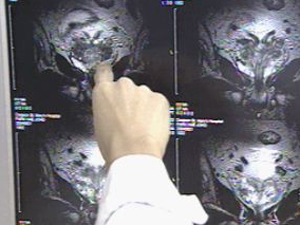 전립선암 급증, 조기 발견이 필수 