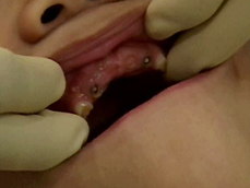 수유 충치, 치아·턱뼈발육에 나쁜 영향 