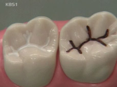 ‘치아 홈 메우기’ 충치 예방에 큰 효과 