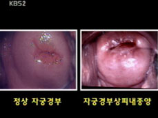 [건강@365] 생명 위협하는 자궁 경부암 