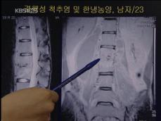 한국 30대 이하 ‘척추결핵 환자’ 급증 