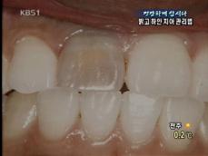 [건강하게 삽시다] 밝고 하얀 치아 관리법 