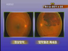 [현장] 소리없이 찾아오는 ‘눈 중풍’ 