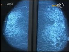 무료 유방암 검사 조기 진단 성과 커 